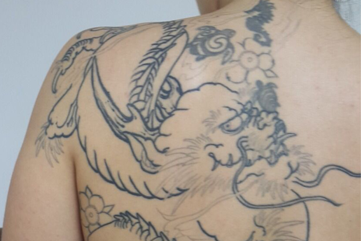 Tatuagem antes do laser
